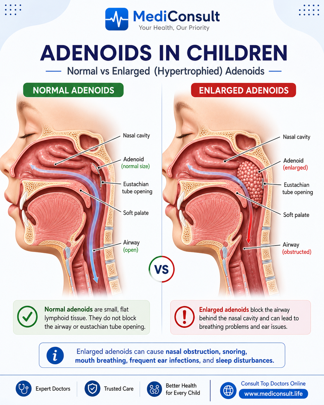 Adenoids in Children: Symptoms, Causes, and Can Homeopathy Help?
