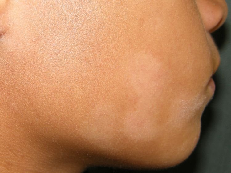 Pityriasis Alba: Causes, Symptoms, and Can Homeopathy Help?