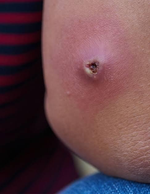 Abscess (ફોડો) શું છે? કેમ થાય છે અને શરીરમાં શું થાય છે?