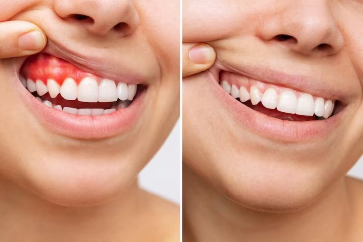 Gum Abscess (પેઢામાં ફોડો) શું છે?