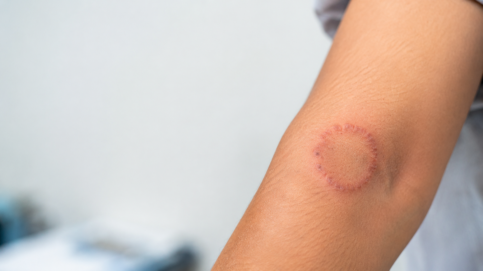 ધાધર (Ringworm) શું છે? કેમ થાય છે? અને કેવી રીતે બચી શકાય?