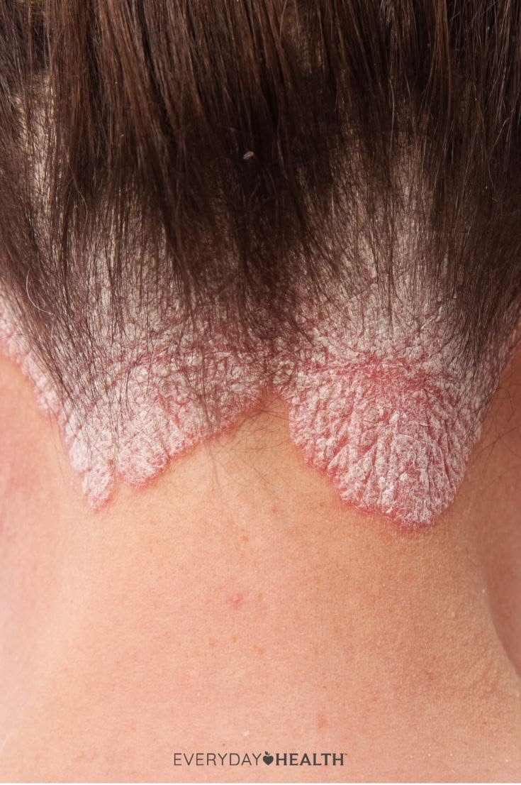 સોરાયસિસ (Psoriasis) શું છે?